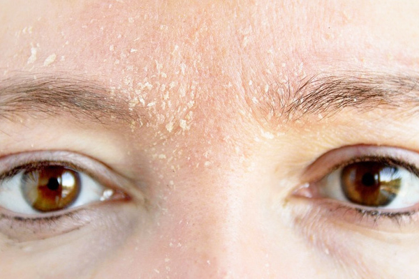 seboreik dermatit