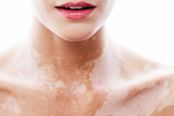 vitiligo tedavisi