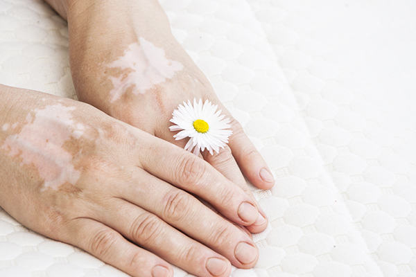 vitiligo