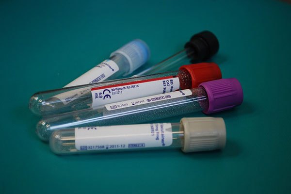 ferritin düşüklüğü saç dökülmesi